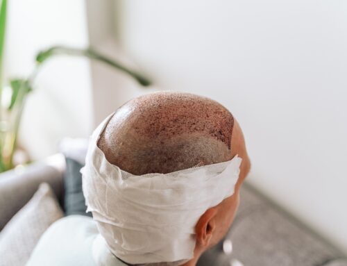 Greffe de cheveux FUE : quelles différences concrètes avec la méthode FUT ?