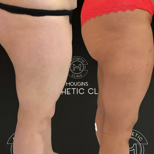 Traitement du lipoed&egrave;me - r&eacute;sultat avant apr&egrave;s