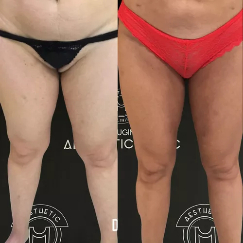 Traitement du lipoed&egrave;me - r&eacute;sultat avant apr&egrave;s