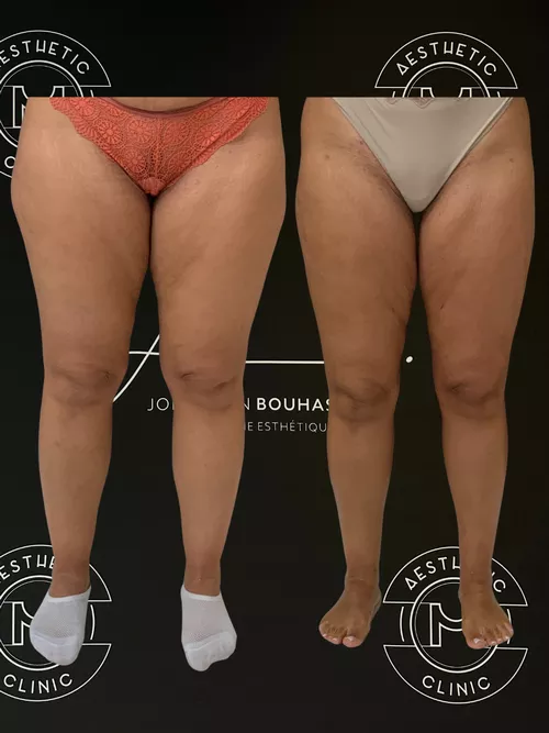 Traitement du lipoed&egrave;me - r&eacute;sultat avant apr&egrave;s