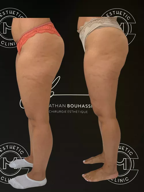 Traitement du lipoed&egrave;me - r&eacute;sultat avant apr&egrave;s