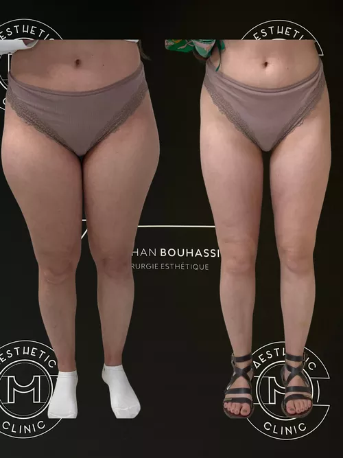 Traitement du lipoed&egrave;me - r&eacute;sultat avant apr&egrave;s