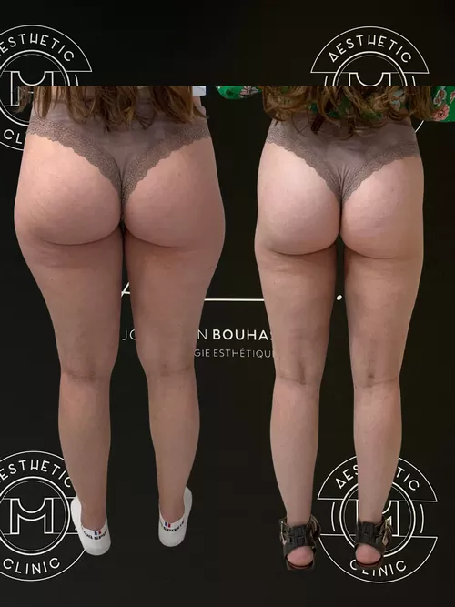 Traitement du lipoed&egrave;me - r&eacute;sultat avant apr&egrave;s