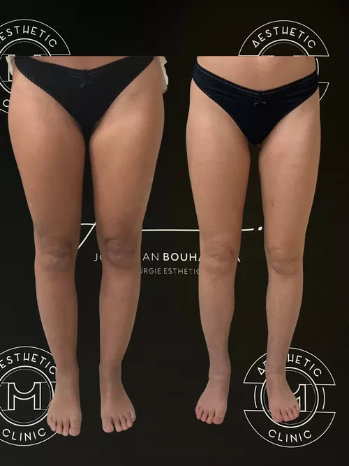 Traitement du lipoed&egrave;me - r&eacute;sultat avant apr&egrave;s