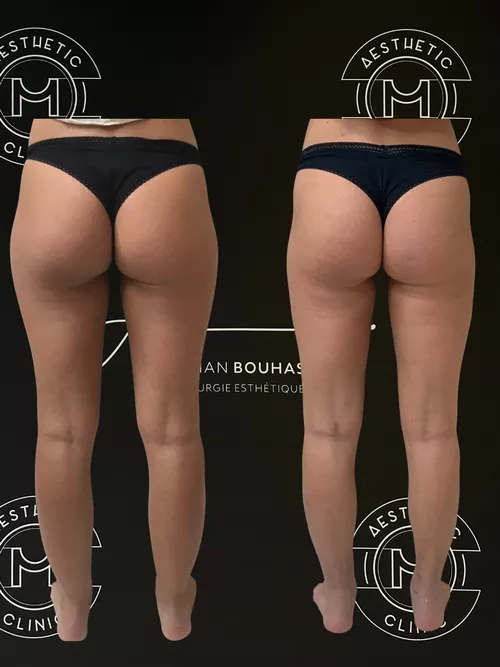 Traitement du lipoed&egrave;me - r&eacute;sultat avant apr&egrave;s