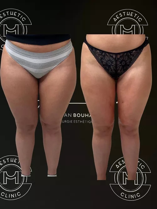 Traitement du lipoed&egrave;me - r&eacute;sultat avant apr&egrave;s