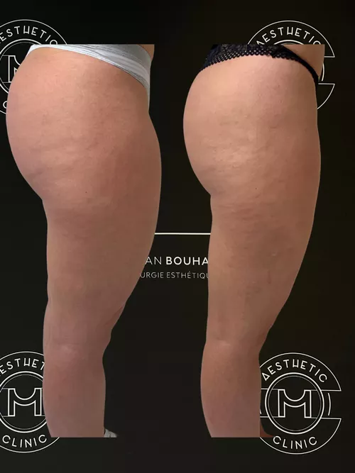 Traitement du lipoed&egrave;me - r&eacute;sultat avant apr&egrave;s