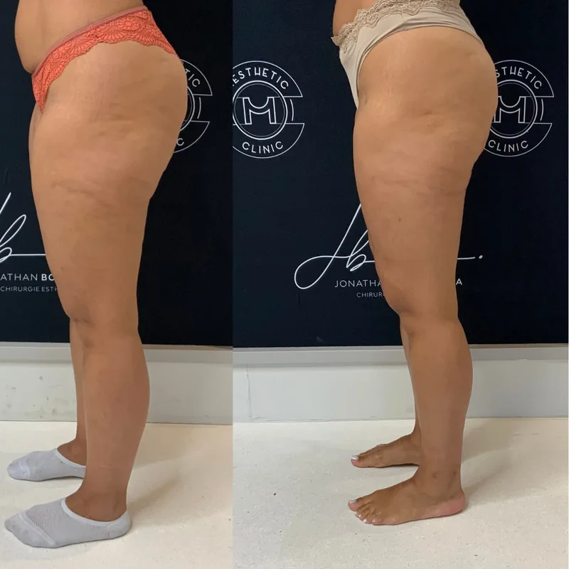 Traitement du lipoed&egrave;me, cas 1 : jambes de profil, avant / apr&egrave;s