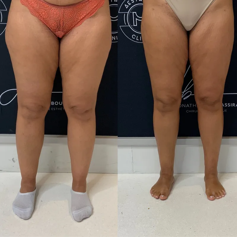 Traitement du lipoed&egrave;me, cas 1 : jambes de face, avant / apr&egrave;s