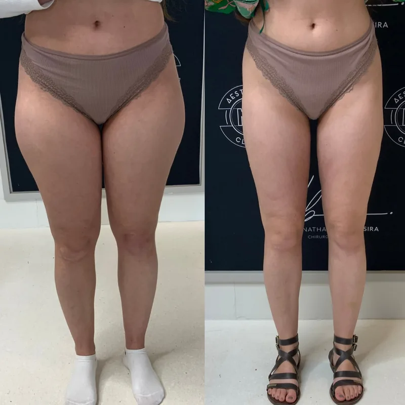 Traitement du lipoed&egrave;me, cas 2 : jambes de face, avant / apr&egrave;s