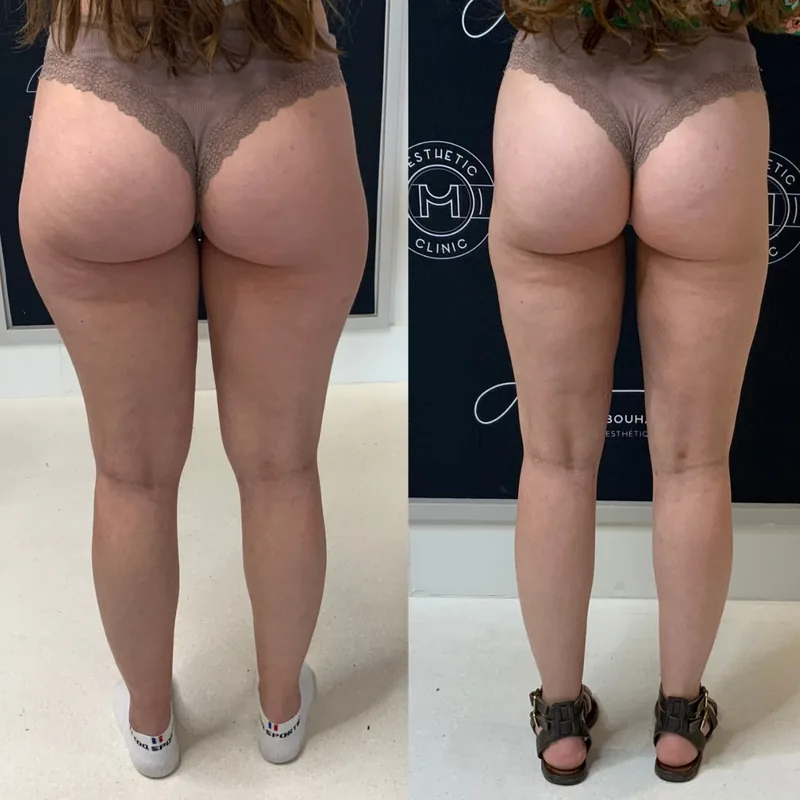 Traitement du lipoed&egrave;me, cas 2 : jambes de dos, avant / apr&egrave;s