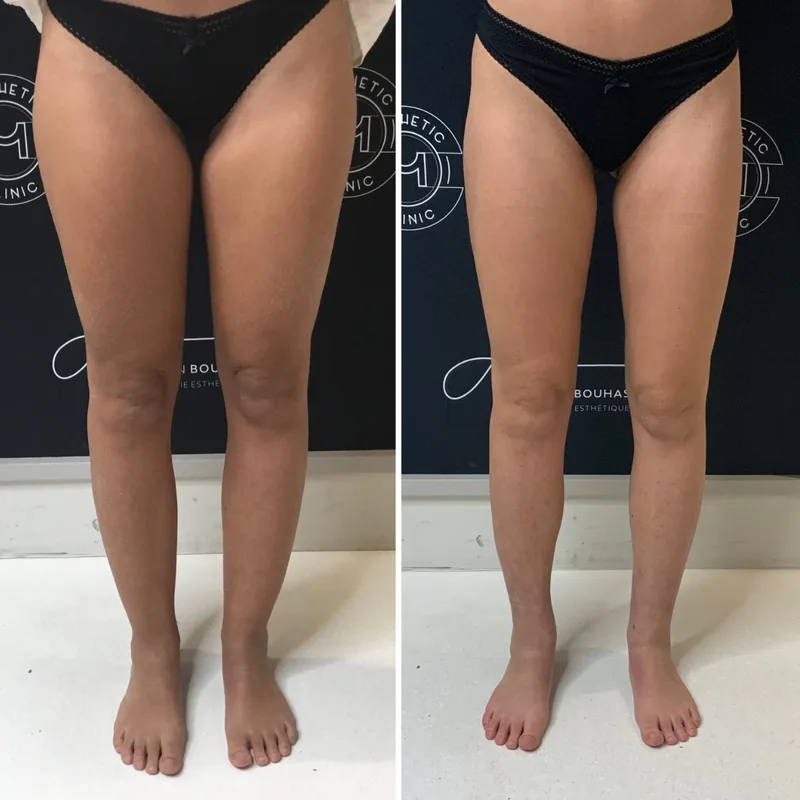 Traitement du lipoed&egrave;me, cas 3 : jambes de face, avant / apr&egrave;s