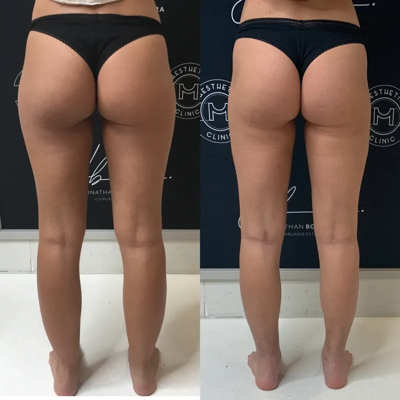 Traitement du lipoed&egrave;me, cas 3 : jambes de dos, avant / apr&egrave;s