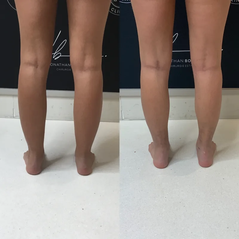 Traitement du lipoed&egrave;me, cas 3 : mollets de dos, avant / apr&egrave;s