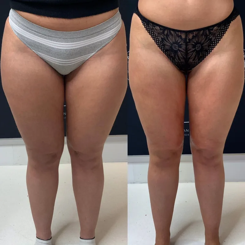 Traitement du lipoed&egrave;me, cas 4 : jambes de face, avant / apr&egrave;s