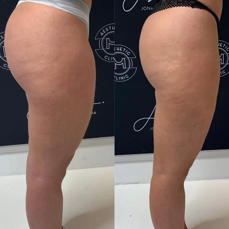 Traitement du lipoed&egrave;me, cas 4 : cuisse de profil, avant / apr&egrave;s