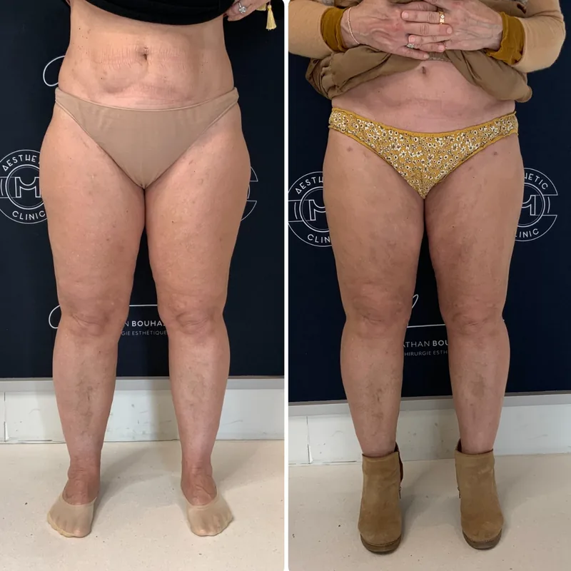 Traitement du lipoed&egrave;me, cas 6 : jambes de face, avant / apr&egrave;s