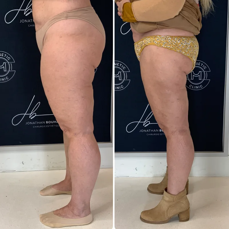 Traitement du lipoed&egrave;me, cas 6 : jambes de profil, avant / apr&egrave;s