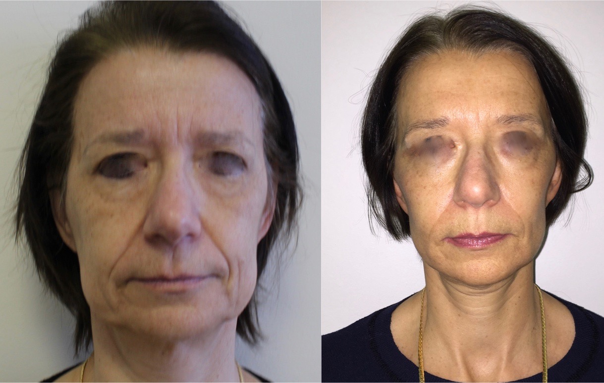 chirurgie du cou et du visage à Antibes, Mougins, Nice, et cannes