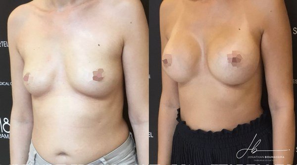 chirurgie des seins à nice, monaco, cannes