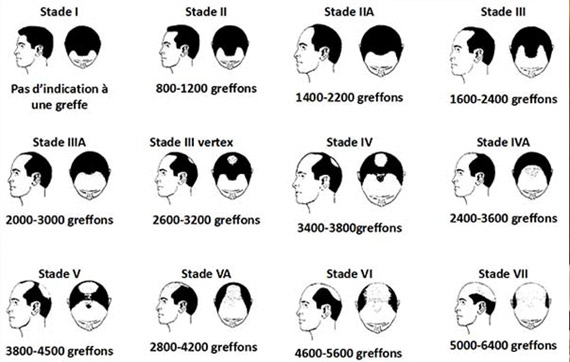 plan de traitement cheveux homme